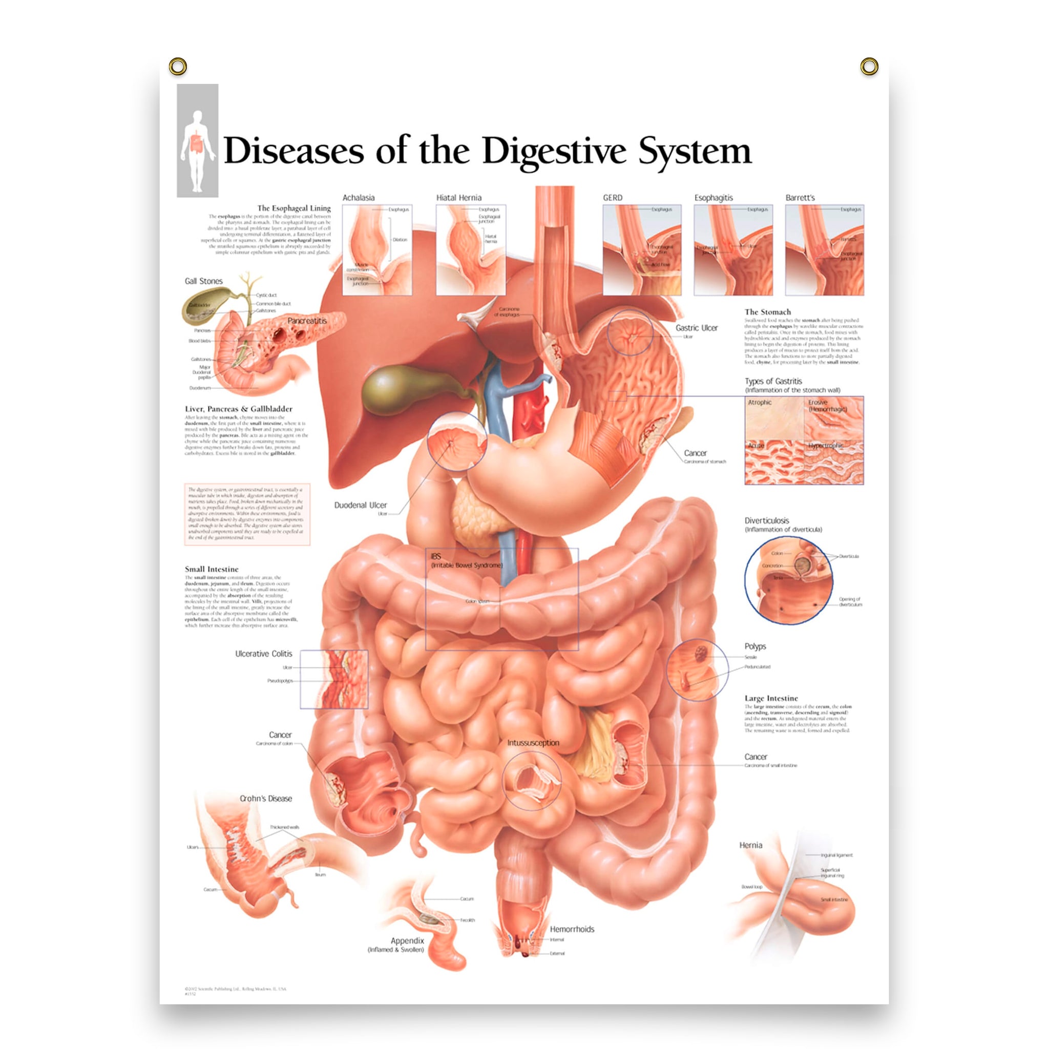 Set of 6 Laminated Medical Posters The Stomach; Understanding The